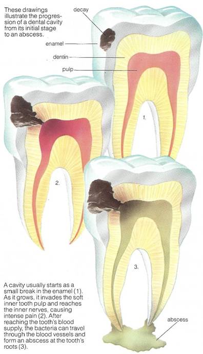 What is a cavity?